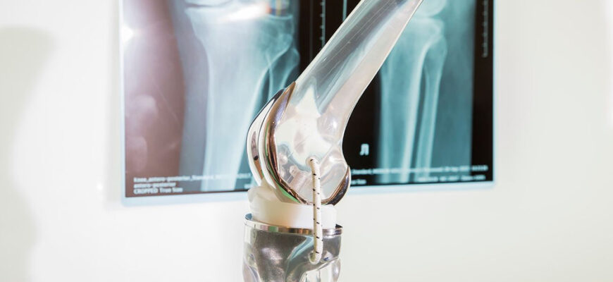 Уровни активности при выборе коленного узла
